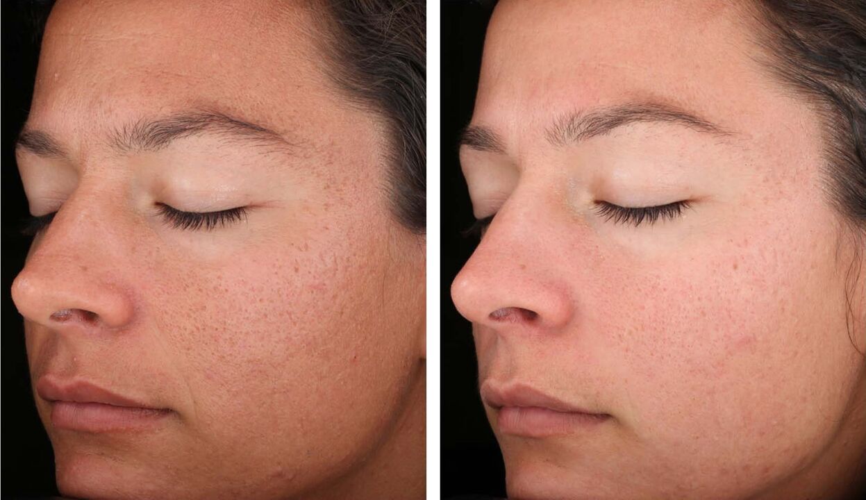 Rajeunissement au laser